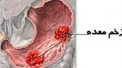 زخم معده